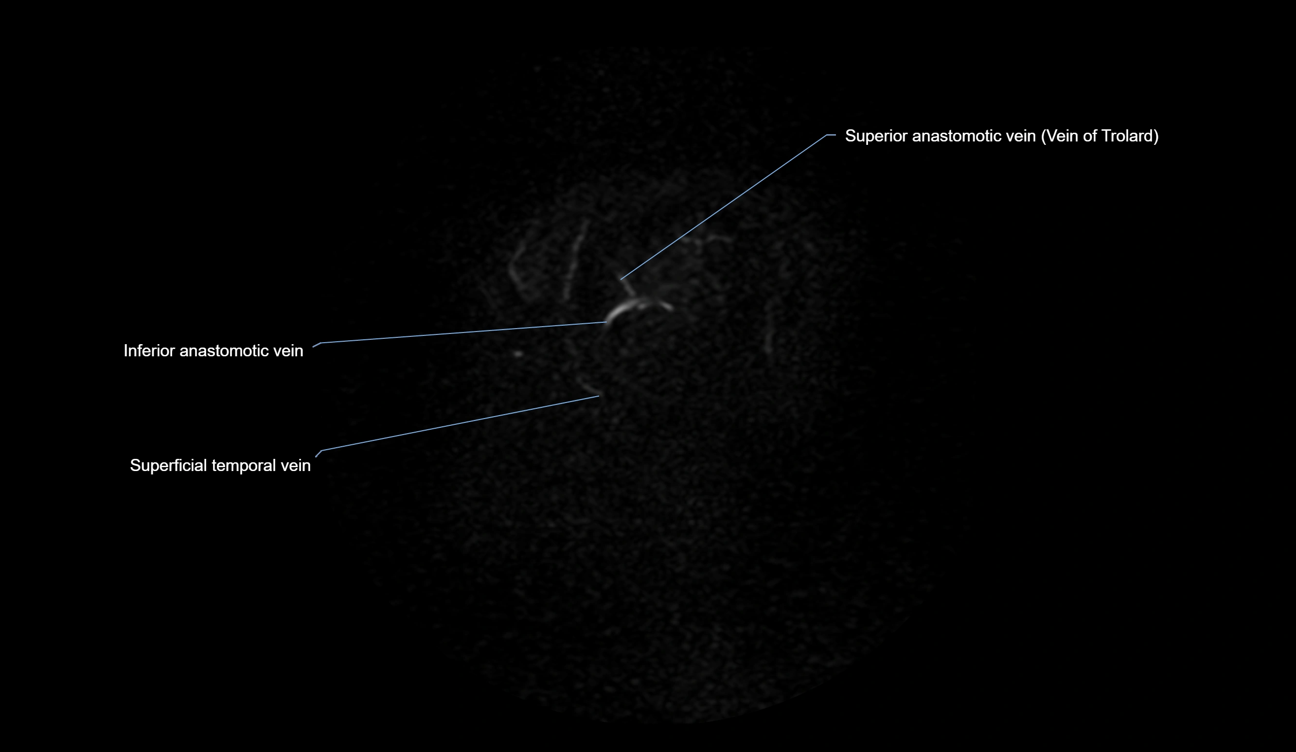 MRV brain sagittal anatomy 3T MRI labelledimages -00076.webp